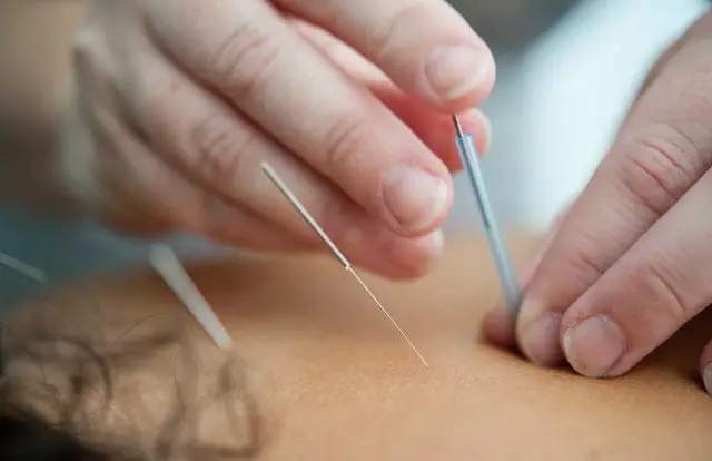 Medicina china acupuntura
